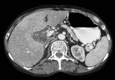 Figure 15: CT scan image showing large bulky necrotic nodes in the peri-pancreatic region.